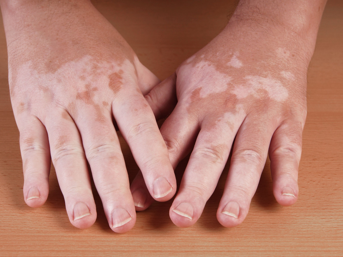 Penyakit vitiligo